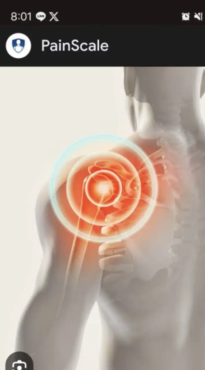 Shoulder pain syndrome