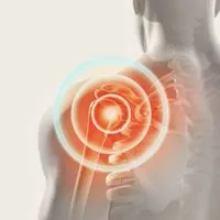 Shoulder pain syndrome