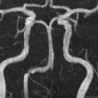 脳卒中クズ人間