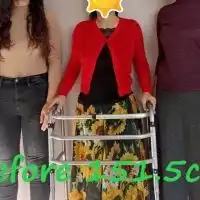 女性のための骨延長 (身長を伸ばす手術)