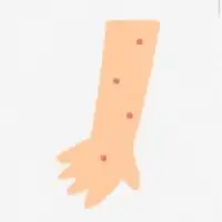 イボをなおす！疣贅、皮膚病等
